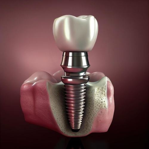 IMPLANTE DENTAL