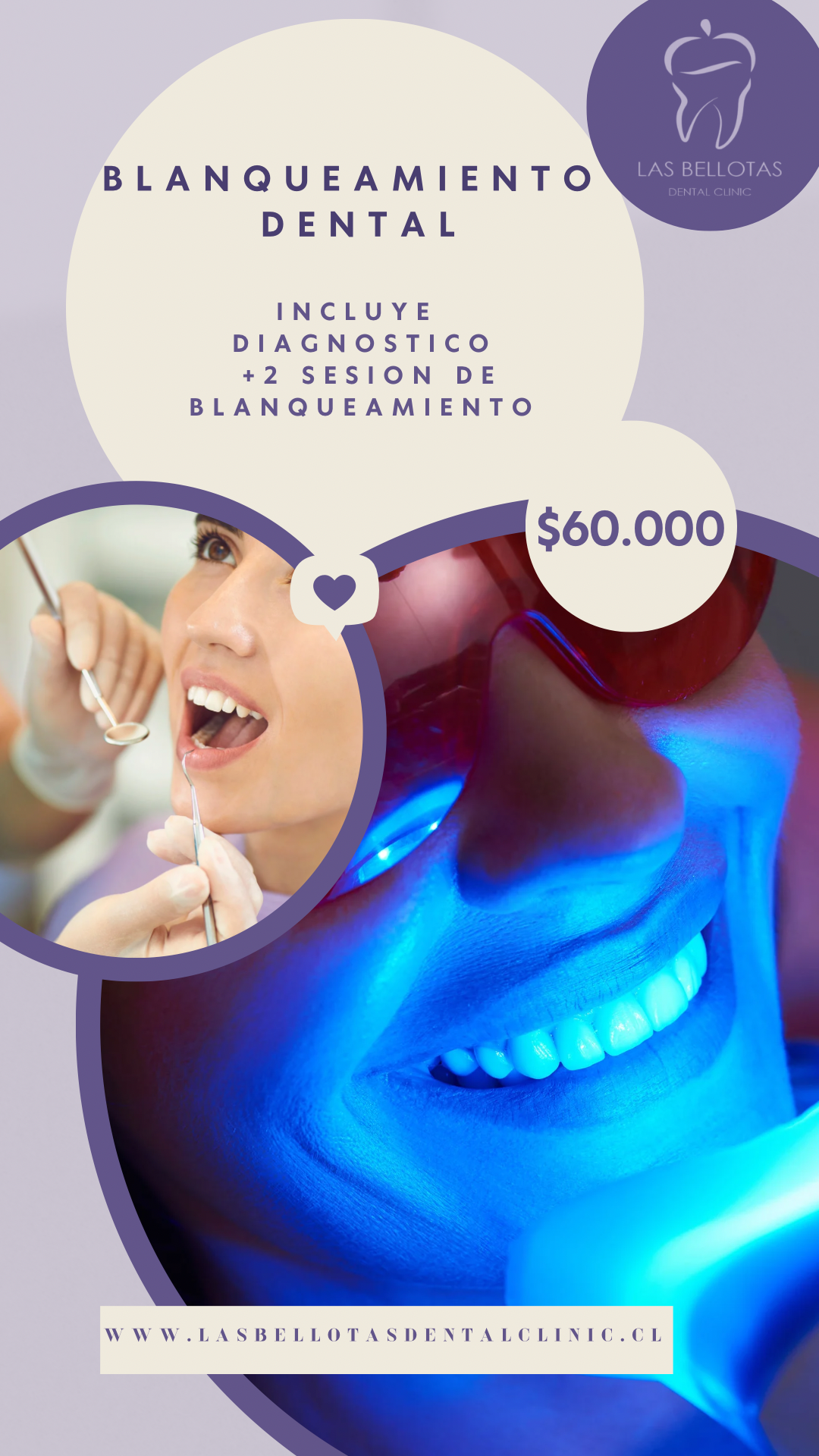 blanqueamiento dental